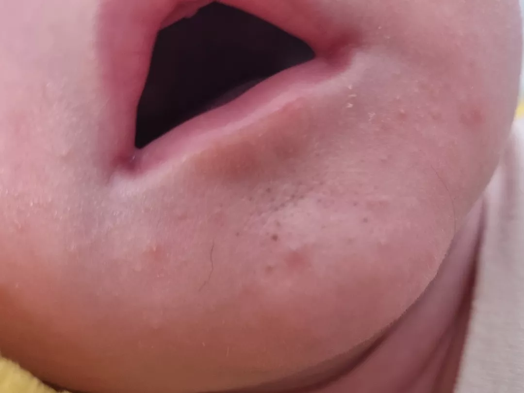 Forbidden pops on my 5 week old baby's chin posted by BunnyFlop2412