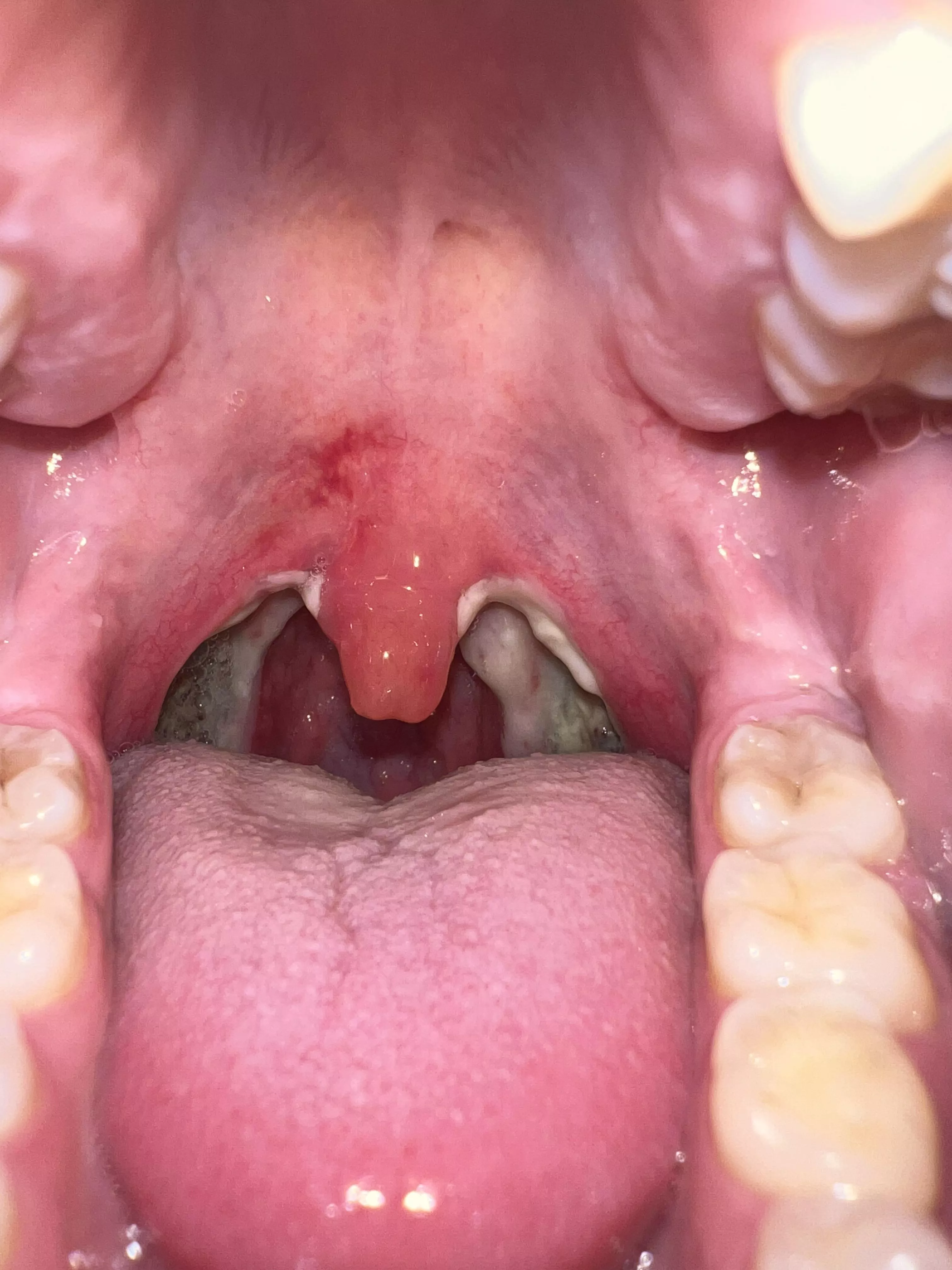 Tonsillectomy day 4 - it’s about to get worse lol posted by truelifeofkaren