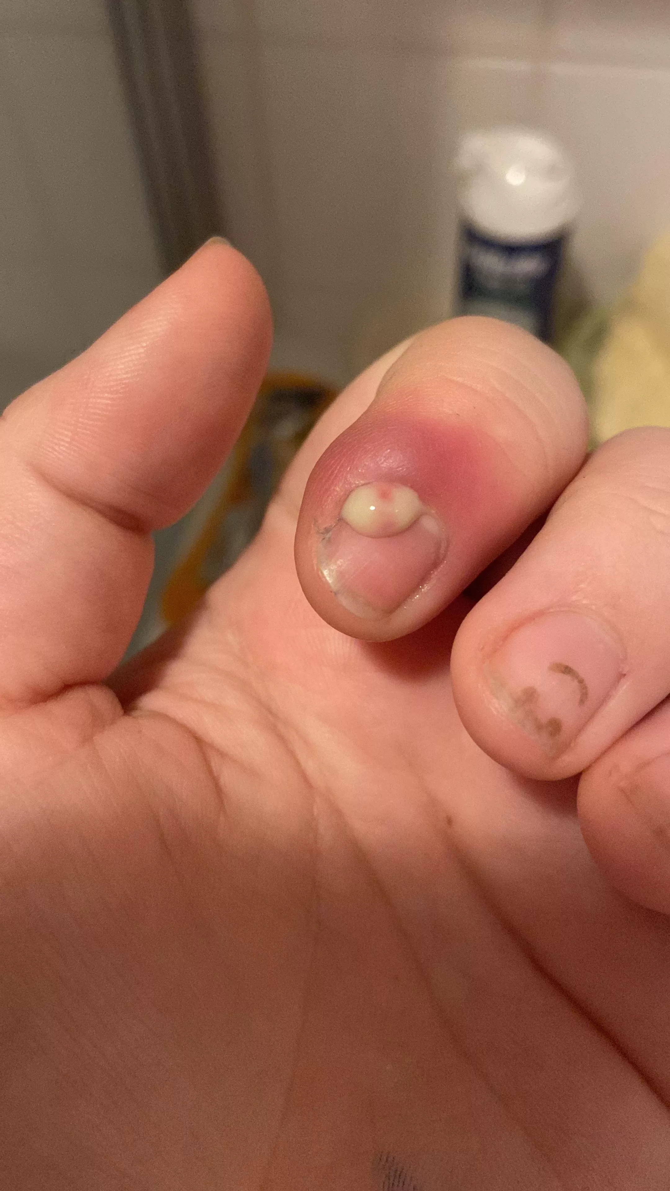 Infected finger popped, this amount times 3 came out (dont mind the paint on my hands i was painting my room) posted by Gay-and-autistic