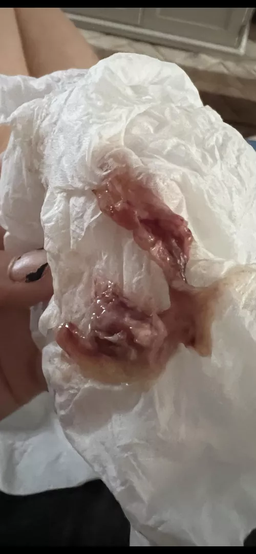 popping related; this came out my nose the other day… does anyone know what this was? by occultra