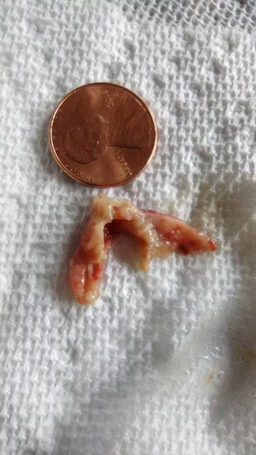 Popping-related - Been dealing with sinus issues this week, and this just came flying out of my nose. Very fleshy/rubbery, and I got instant relief in half of my nose. posted by SamuelCakes