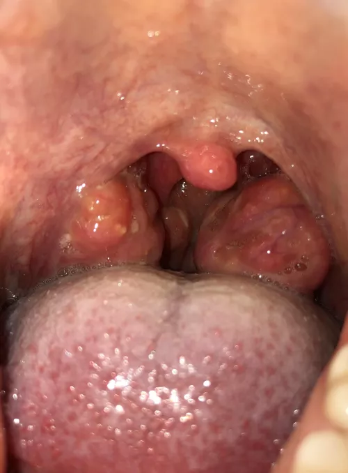 Saw someone post their tonsillectomy recovery results so I got inspired to post a photo of my tonsils before I got my tonsillectomy lol by anonymous311997