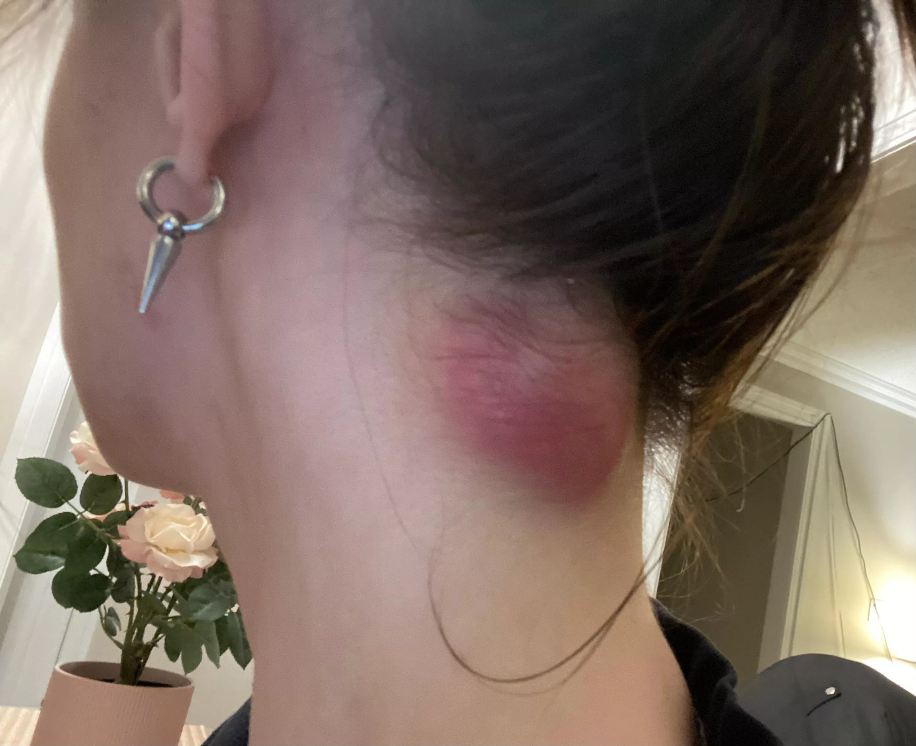 [Cyst] Has anyone ever had anything like this? I have surgery scheduled in 10 days, waiting feels unbearable. Diagnosed as an epidermoid cyst. Present for almost 2 months, absolutely huge and chronically inflamed/painful. Sticks out of my neck like a ten posted by softghost7
