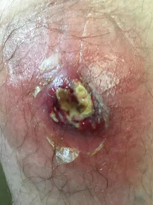 How many use inhalers and have skin problems ? by Ryattmcgee