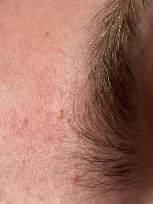 Little blackhead above my friends brow and the hole it left by discolemonvde