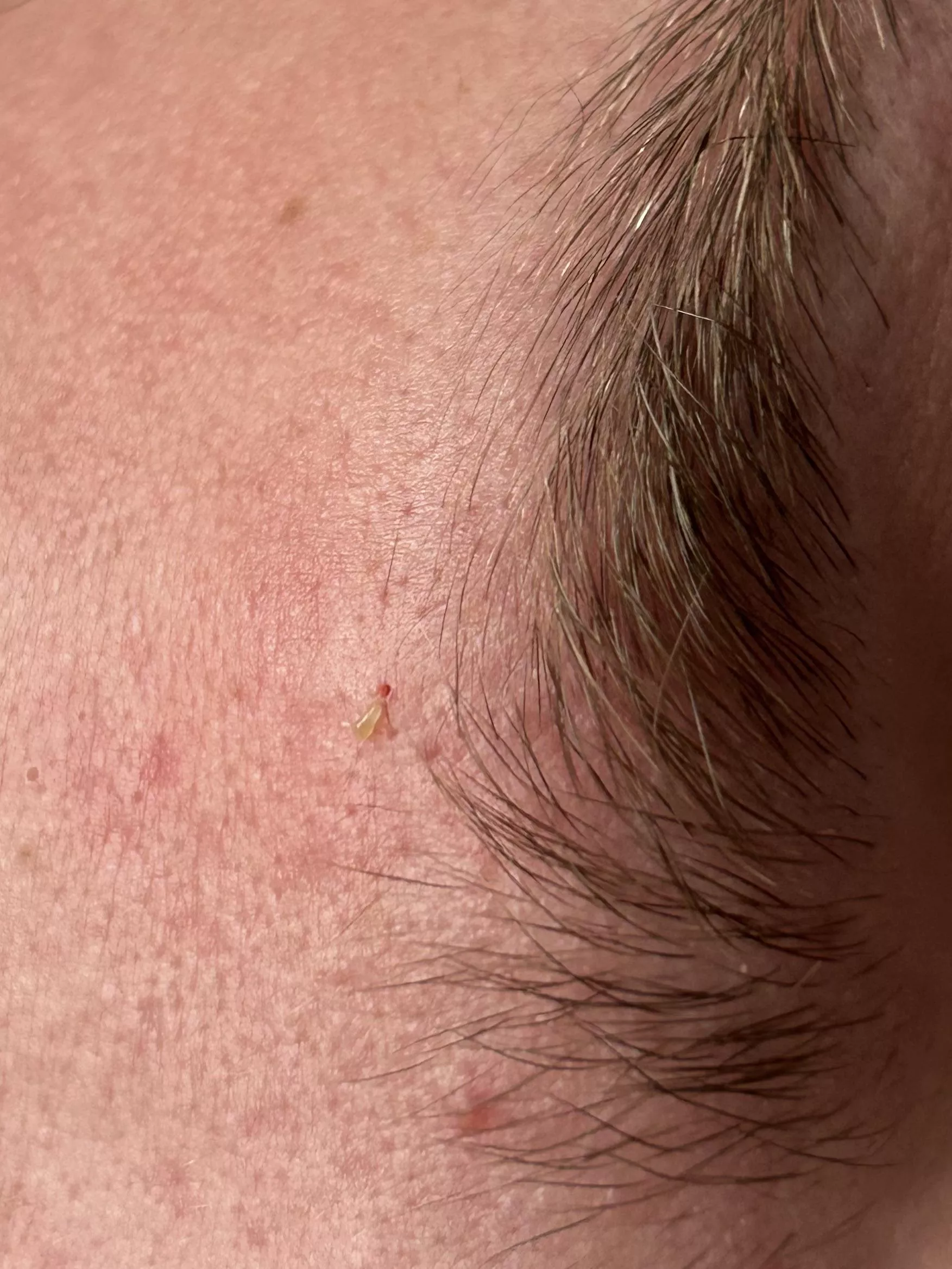 Little blackhead above my friends brow and the hole it left posted by discolemonvde