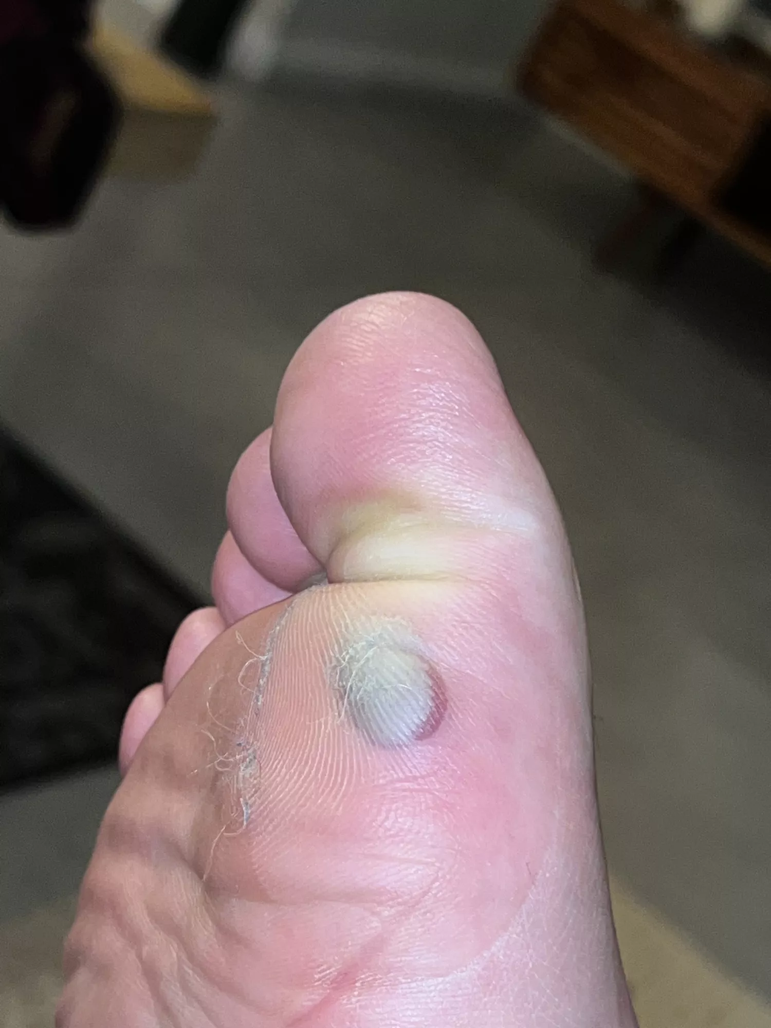 The urge to pop it is overwhelming posted by wraplan