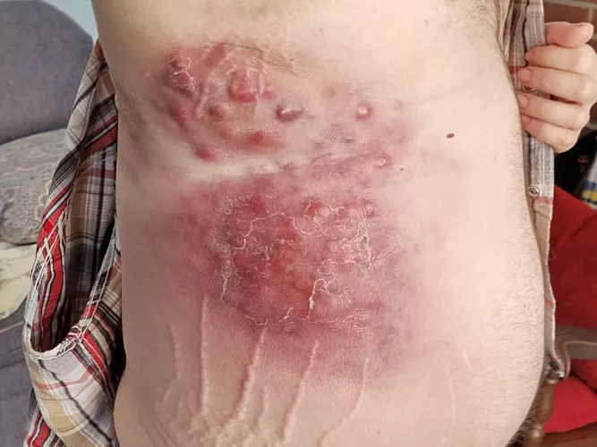 First time,. Forbidden pops, stage 4 skin cancer. by jjfc00