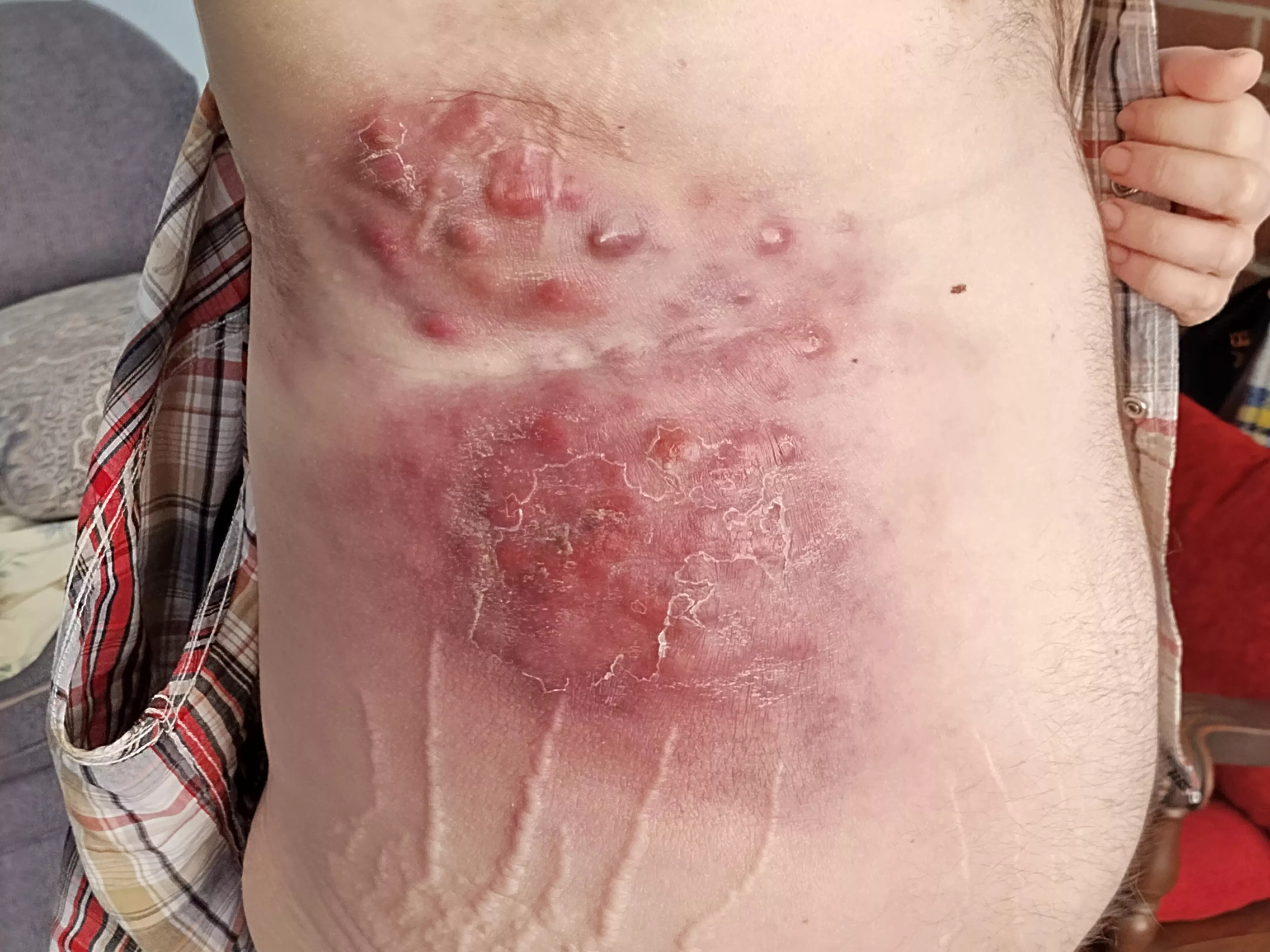 First time,. Forbidden pops, stage 4 skin cancer. posted by jjfc00