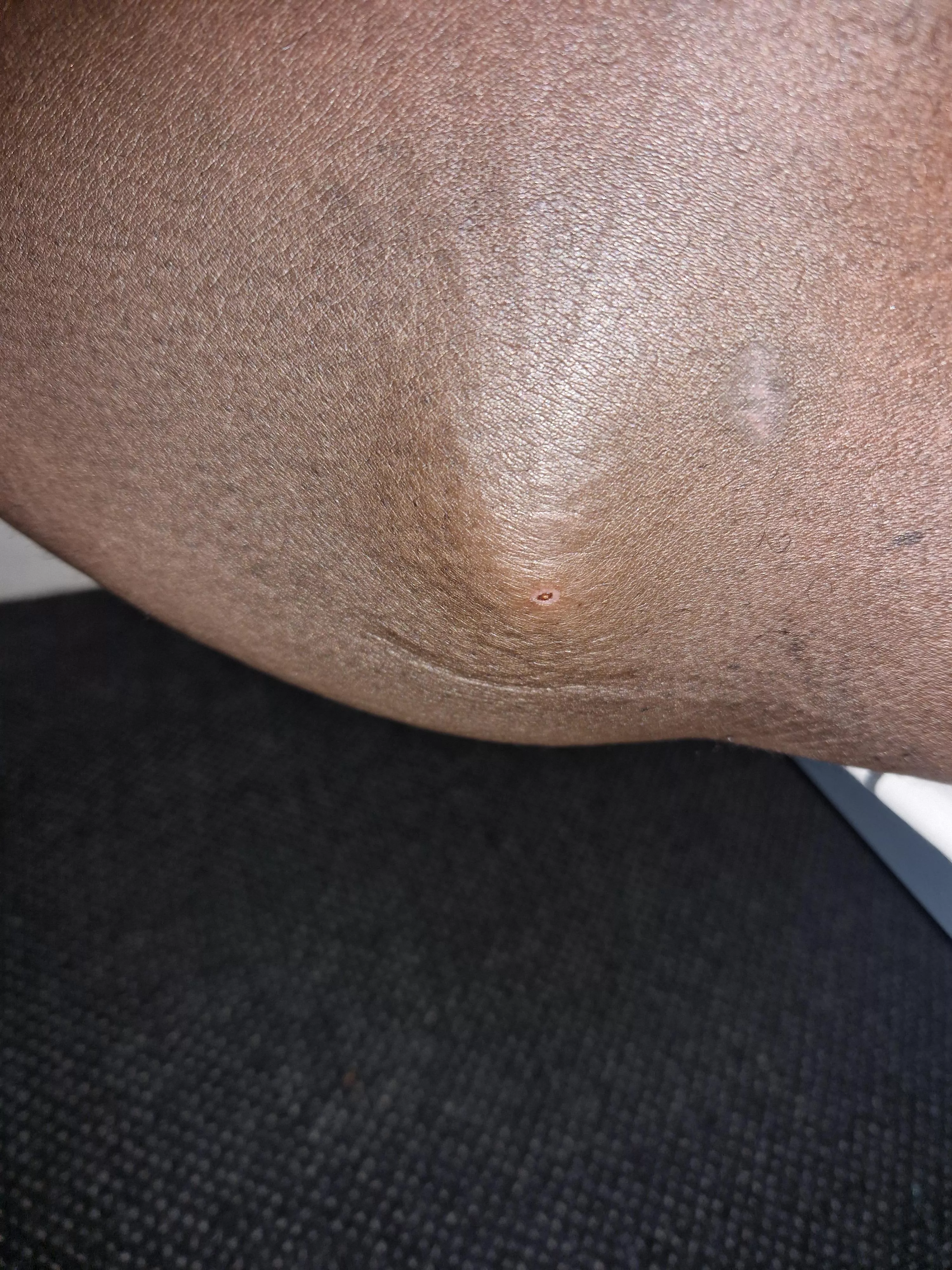 Stiff, hard and painful. Feels like an egg in my thigh. Can't walk without pain. What could it be and what to do posted by pleasant__sheep