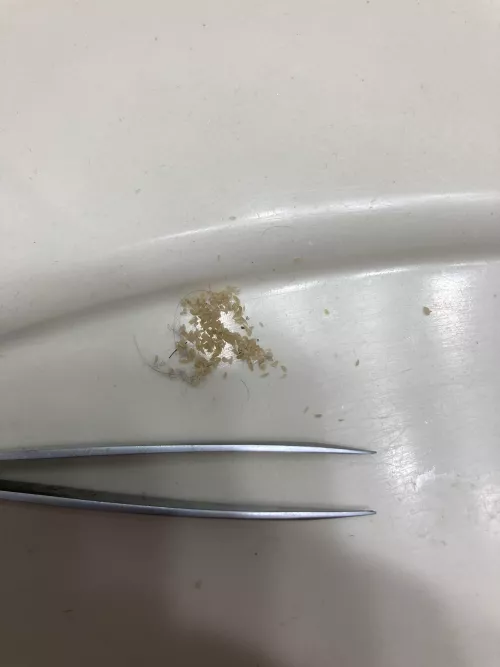 I don’t know what else to do with this picture. All of the blackheads I squeezed out of my nose in about 2 hours. by Longjumping-Dot-4824