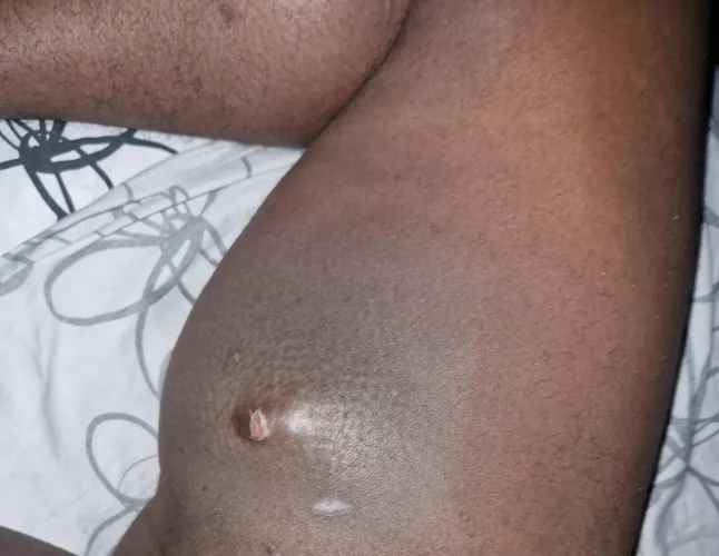 It's been 5 days and head still dry. Hope it gets better soon so I can upload a pop! by pleasant__sheep