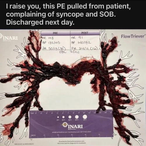 Look at this size of this lung clot! Imagine how much better you’d feel after it was out! by Easy-Hovercraft-6576