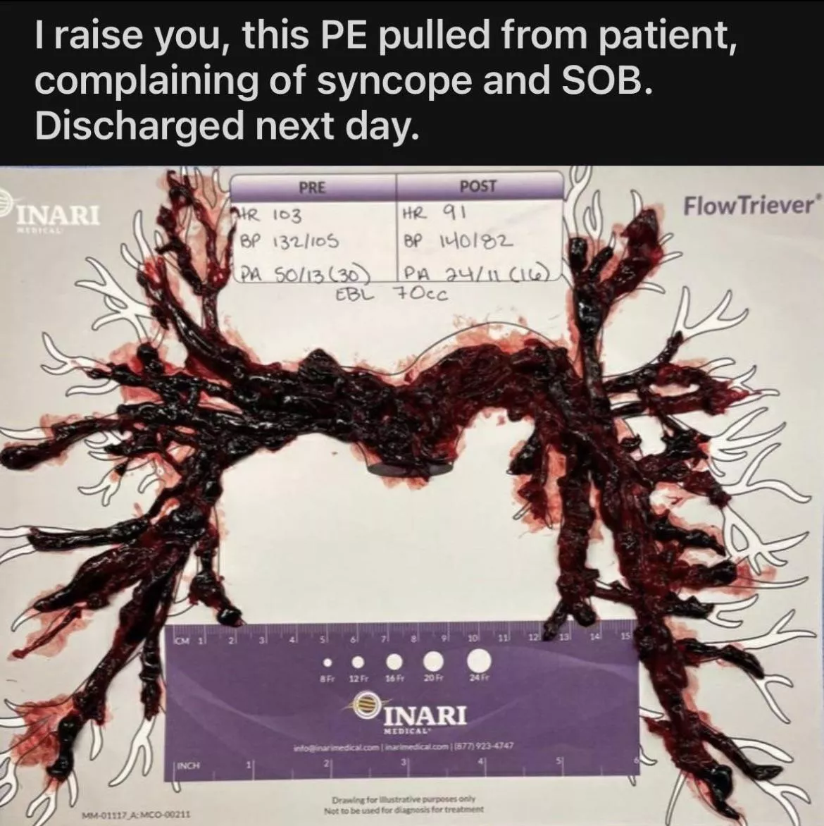 Look at this size of this lung clot! Imagine how much better you’d feel after it was out! posted by Easy-Hovercraft-6576