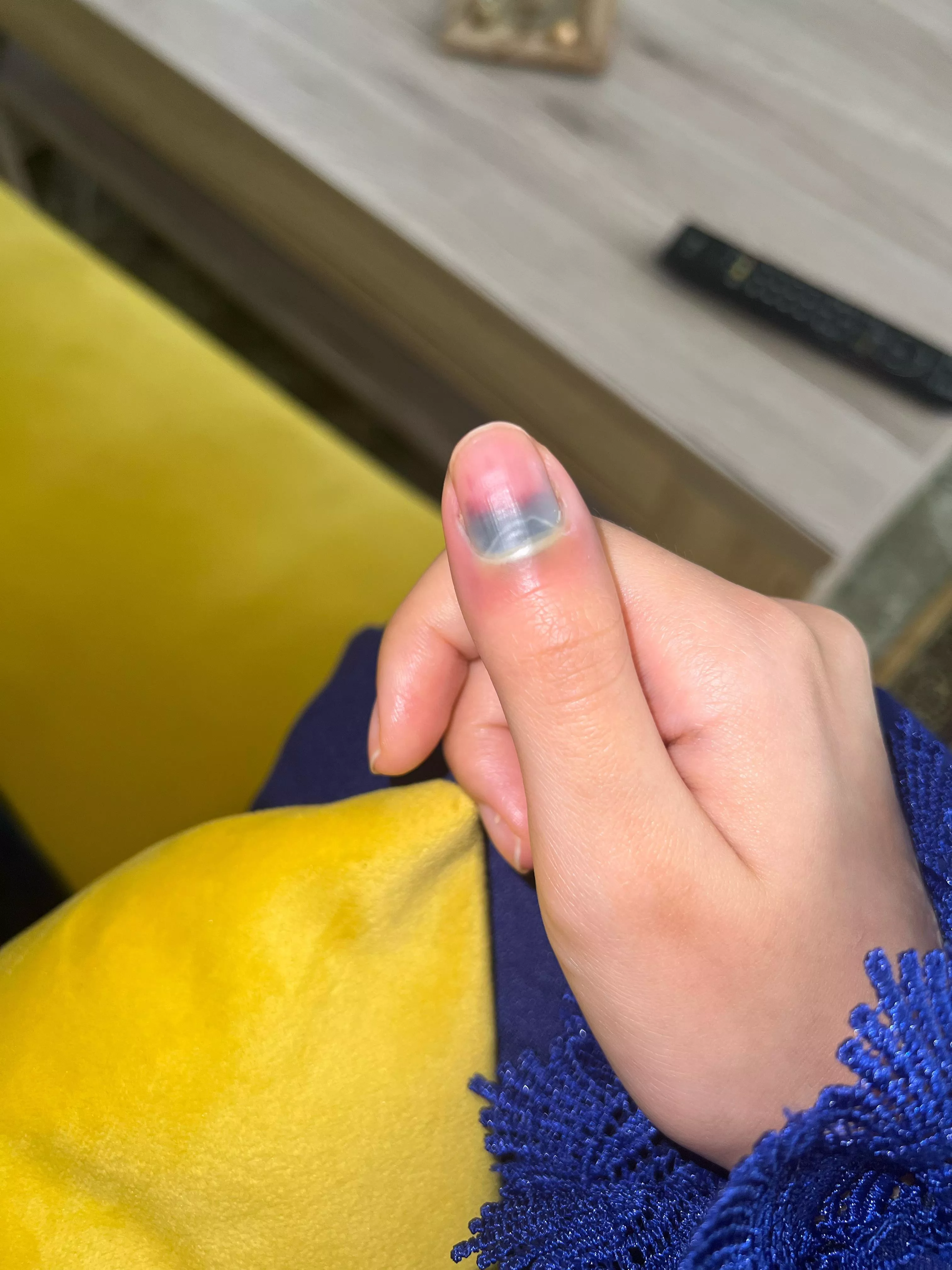 Subungual hematoma pus , should i let it heal by itself ? Or go to a doctor ? posted by CompetitiveAppeal517