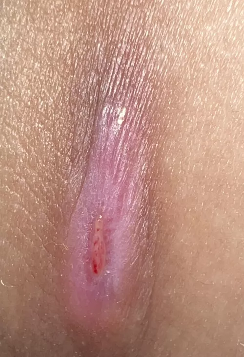 Anyone know what type of cyst this is? It’s near the upper thigh area and has already popped several times. (It popped recently and still hasn’t healed) by u_cheez