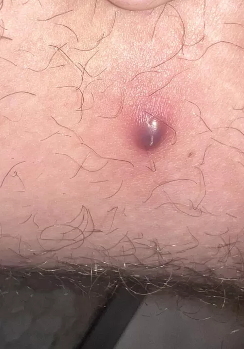 Dark purple Boil on inner thigh by Ok-Researcher-5456