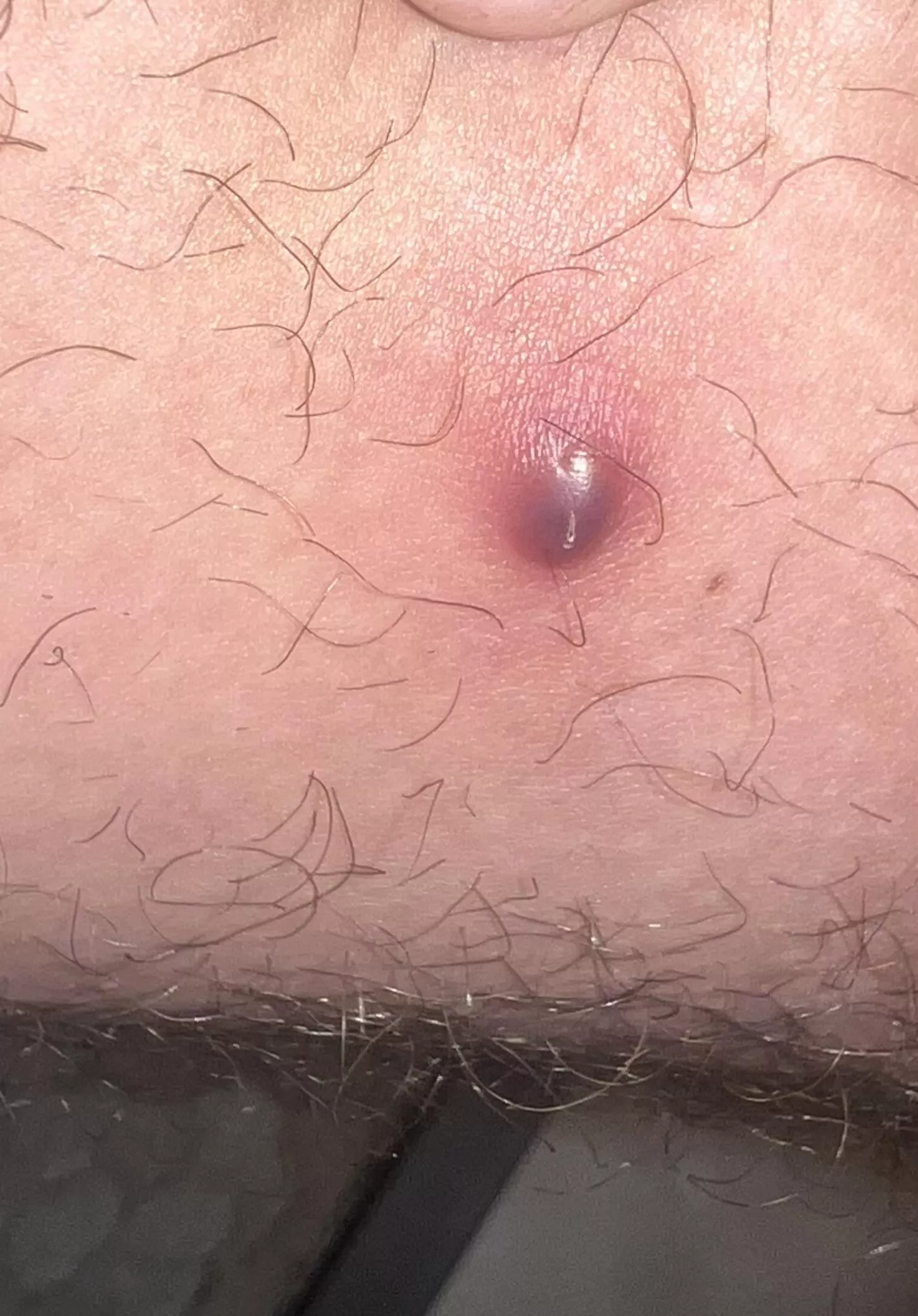 Dark purple Boil on inner thigh posted by Ok-Researcher-5456