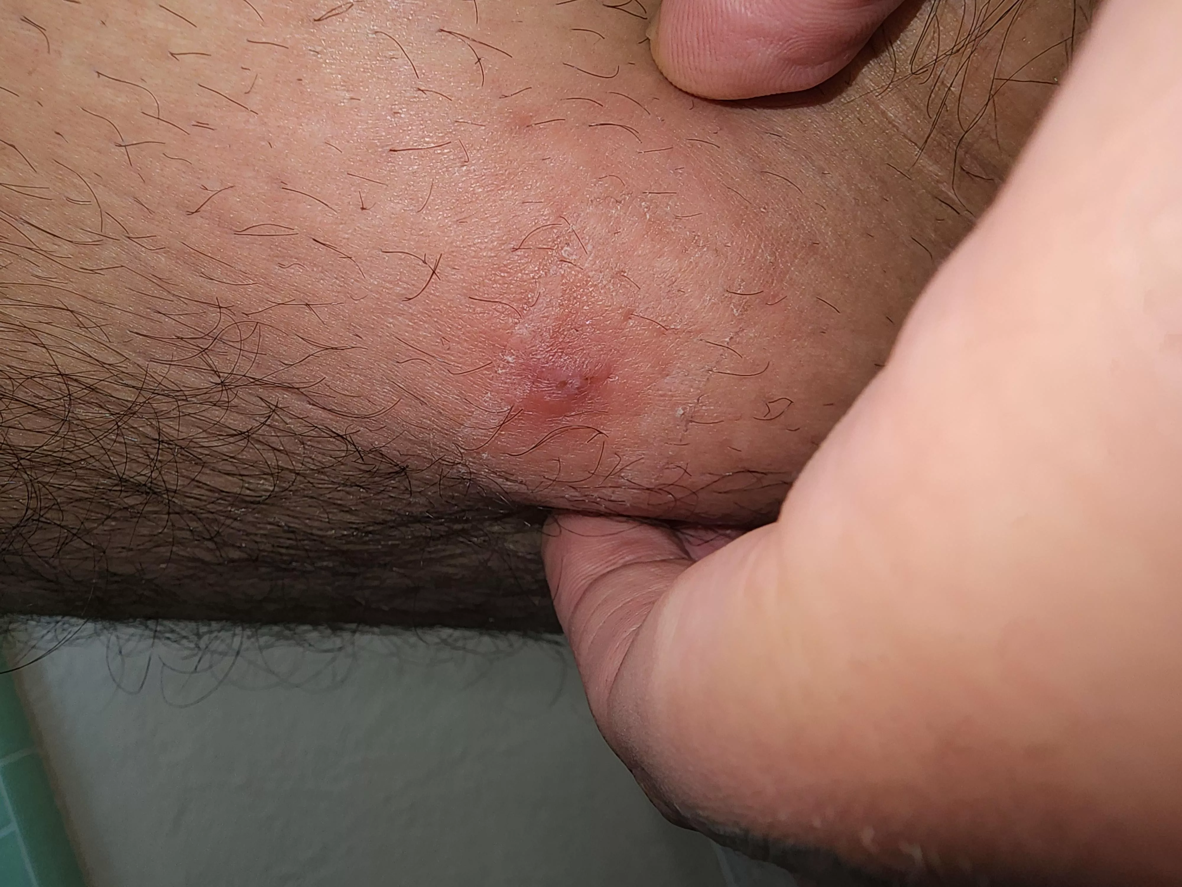 Ingrown hair l? It came to a slight head but I drained it a bit. posted by galick_gunn