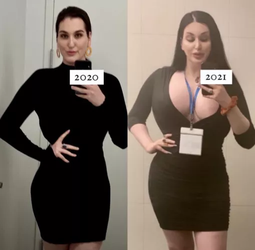 [TS] Bimbo Progression (850cc Implants, FFS, Lip Filler) by YouFlimsy2061