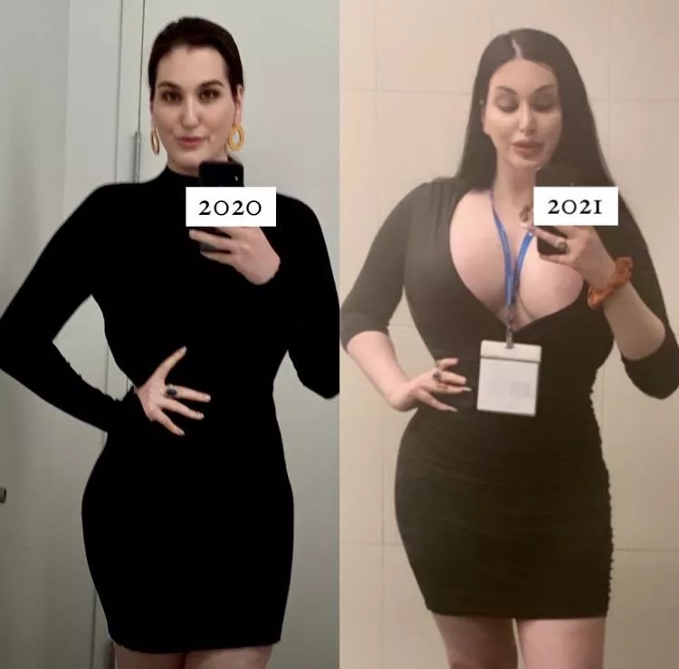 [TS] Bimbo Progression (850cc Implants, FFS, Lip Filler) posted by YouFlimsy2061