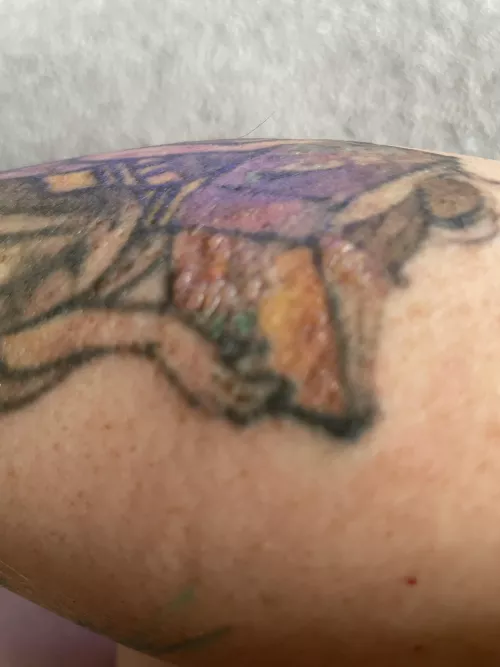 I’m getting a tattoo removed and had a treatment yesterday. Left some nice forbidden pops on the colored sections today. by TheSewseress