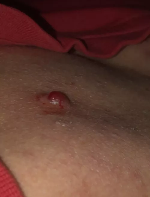 Its been weeks since I last picked it. Picked the crust and now its bleeding badly… Im thinking it may never go😬 by heat_wave29