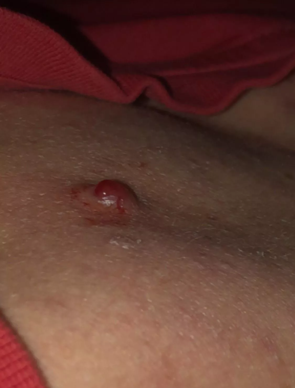 Its been weeks since I last picked it. Picked the crust and now its bleeding badly… Im thinking it may never go😬 posted by heat_wave29