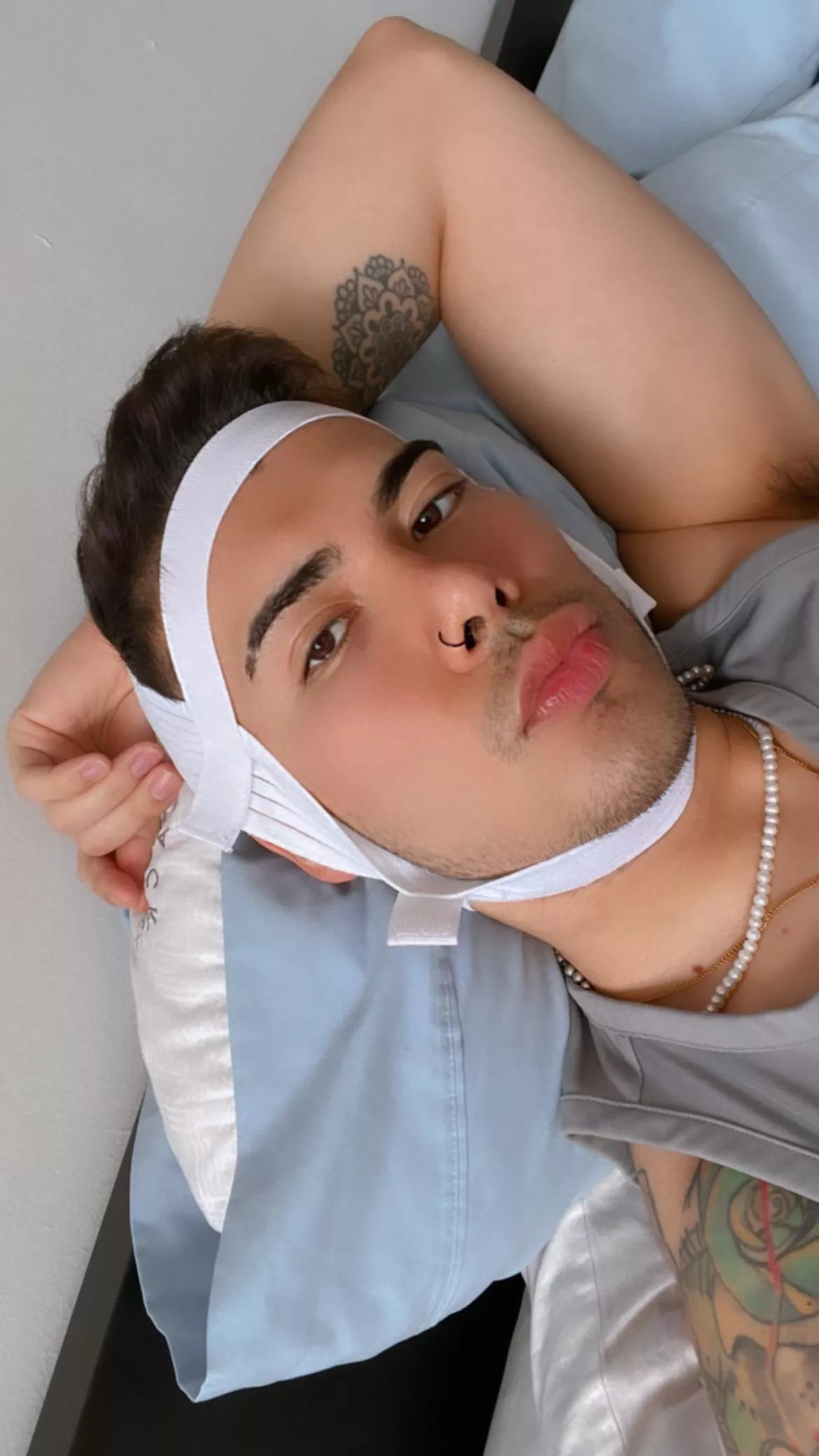 3 days post kybella 🥲 posted by Kind_Giraffe4800