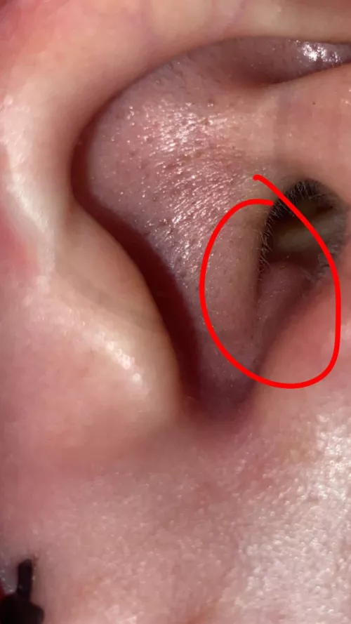 i have this blackhead pimple type thing in my ear and it hurts so bad, i tried to pop it a couple times but i’m gonna just leave it and keep applying warm compress now cuz it hurts too bad lol by zombiekiller14