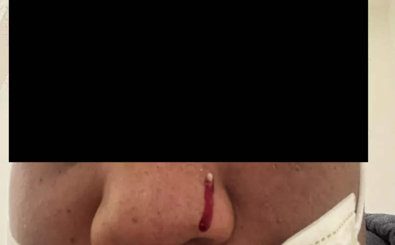 One of the worst pops I’ve had in my life. It hurt so bad before and hurt bad when I popped it. It hit the mirror too and bled bad after. Never had a pimple this bad before in my 28 years of living. by AlarmVarious1991