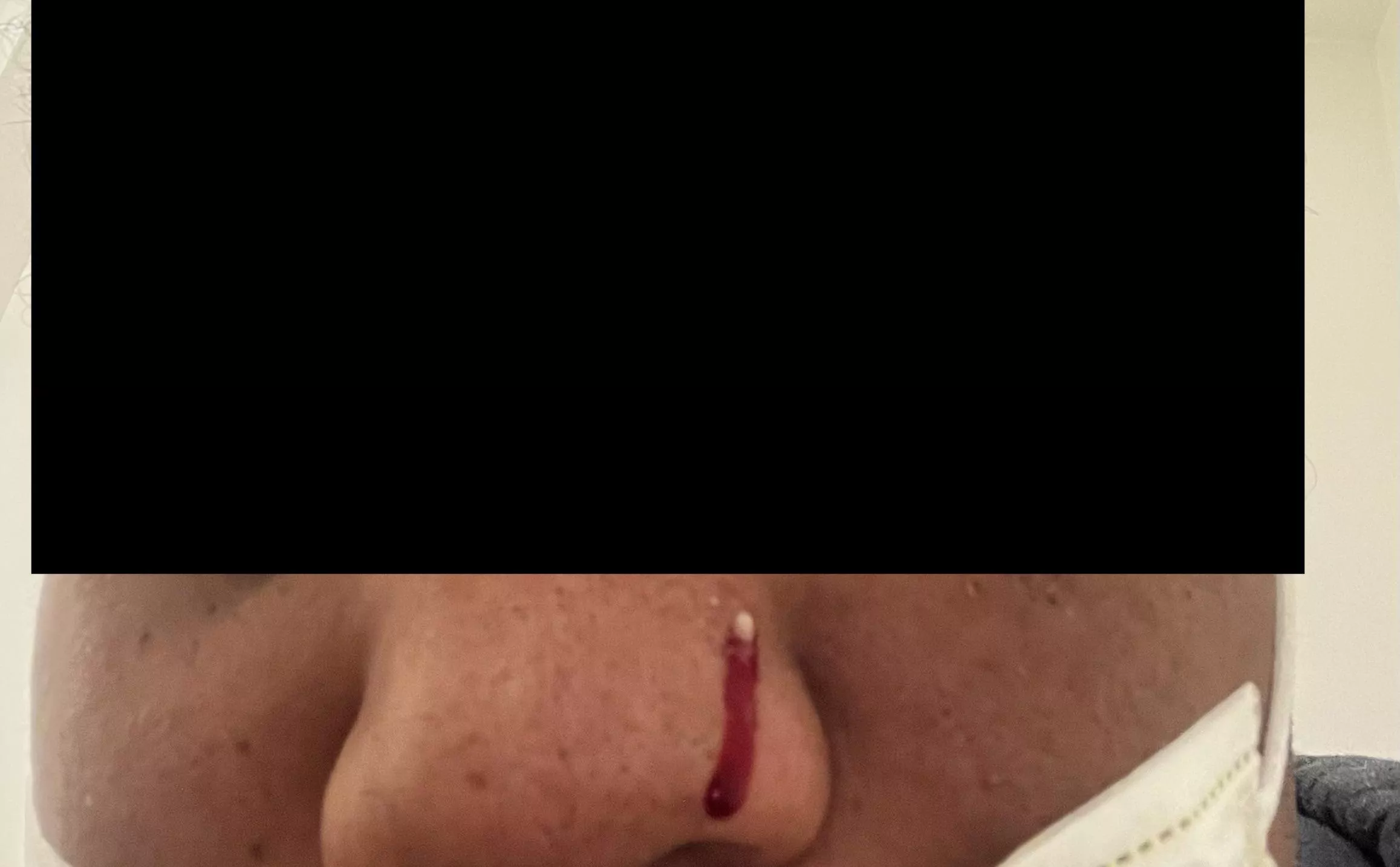 One of the worst pops I’ve had in my life. It hurt so bad before and hurt bad when I popped it. It hit the mirror too and bled bad after. Never had a pimple this bad before in my 28 years of living. posted by AlarmVarious1991
