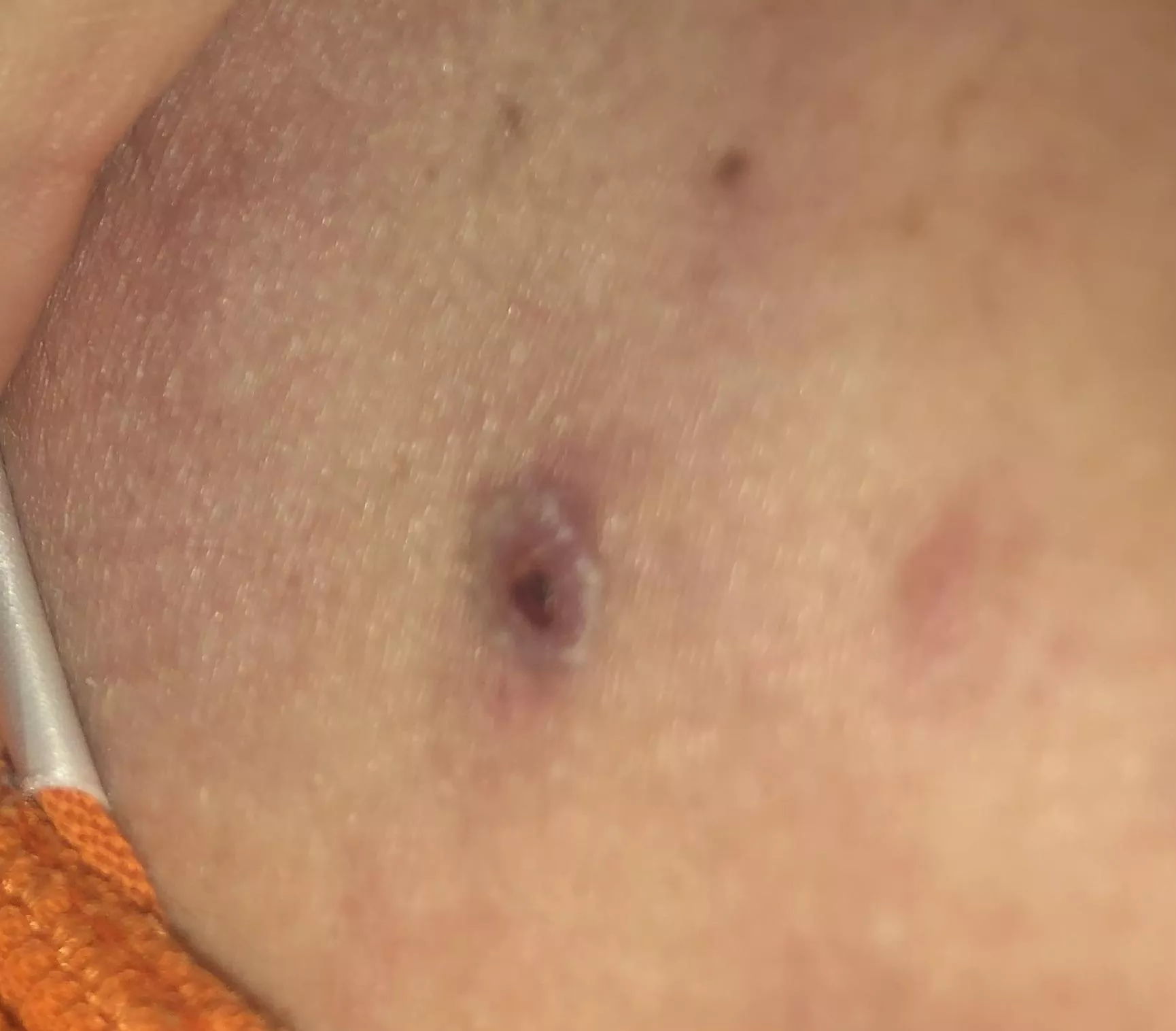 Should I get it looked at? It used to be a bleeding cyst. posted by heat_wave29