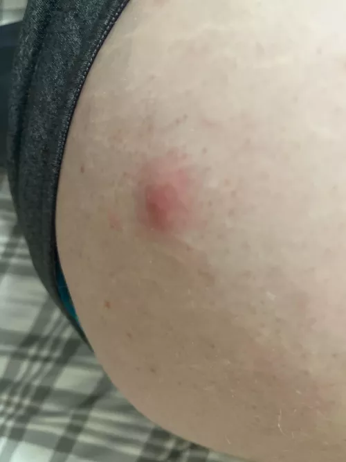 These keep appearing on my thigh, and I try to remove them, but they keep appearing. What are these? (NSFW for pic being taken near butt.) by shshbssbsh