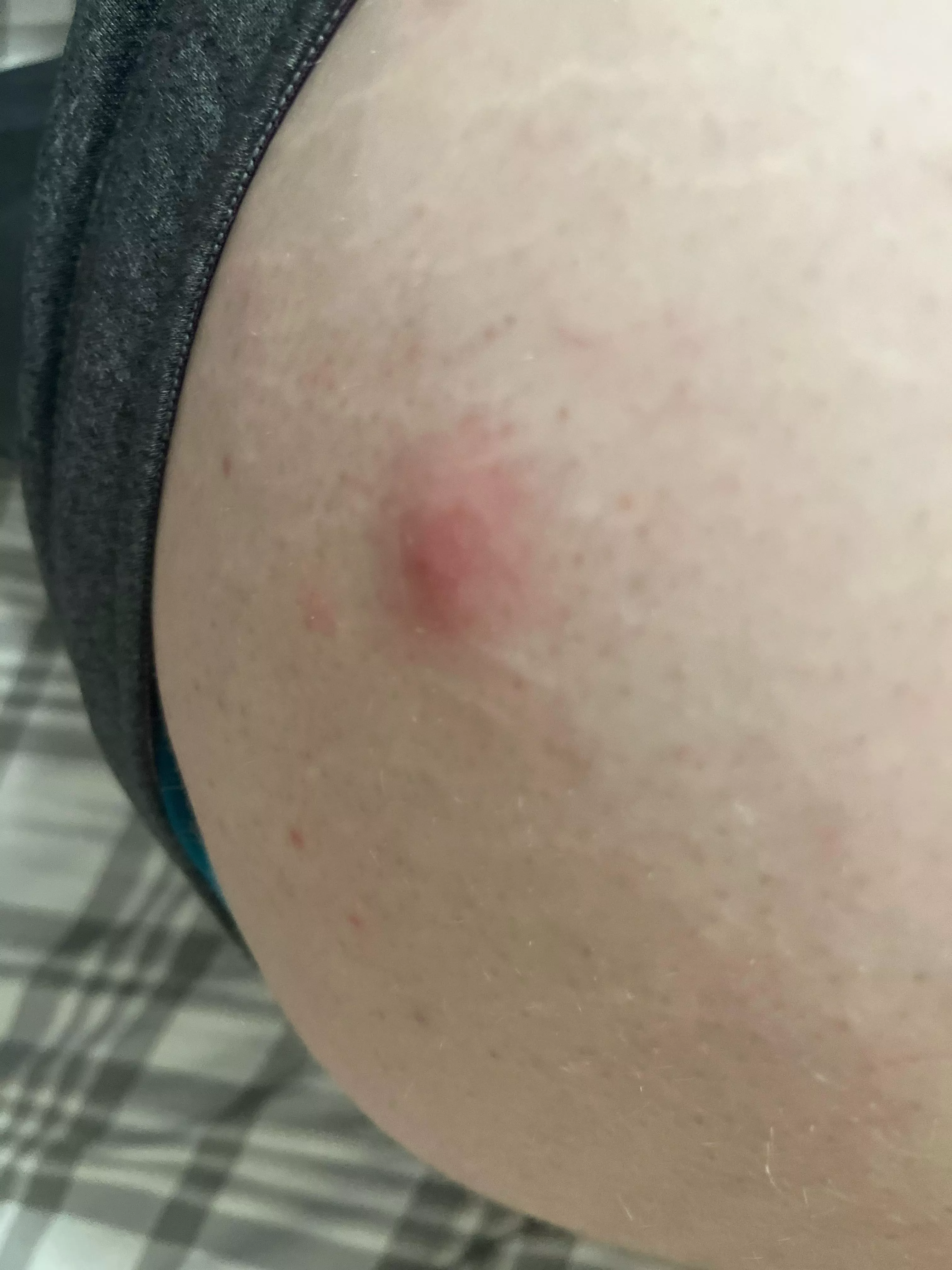 These keep appearing on my thigh, and I try to remove them, but they keep appearing. What are these? (NSFW for pic being taken near butt.) posted by shshbssbsh