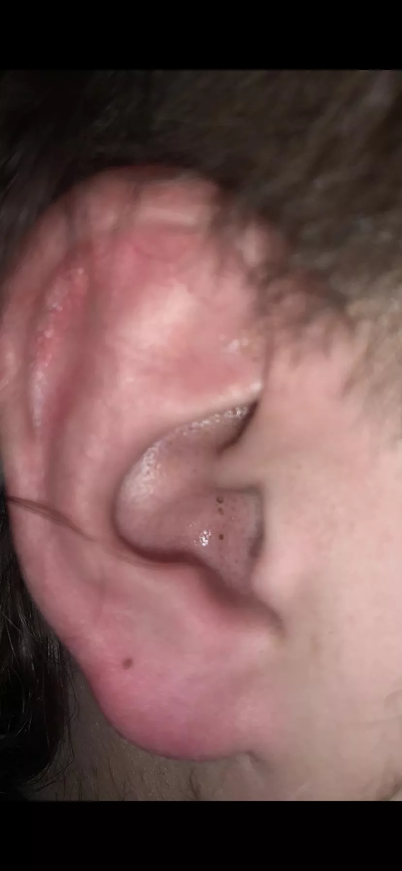 Blackheads in my boyfriend’s ear, he won’t let me pop them!!! posted by mercurypistol