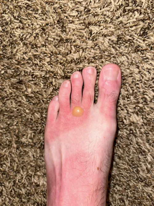 PSA: wear your sunscreen by Fullsenderson