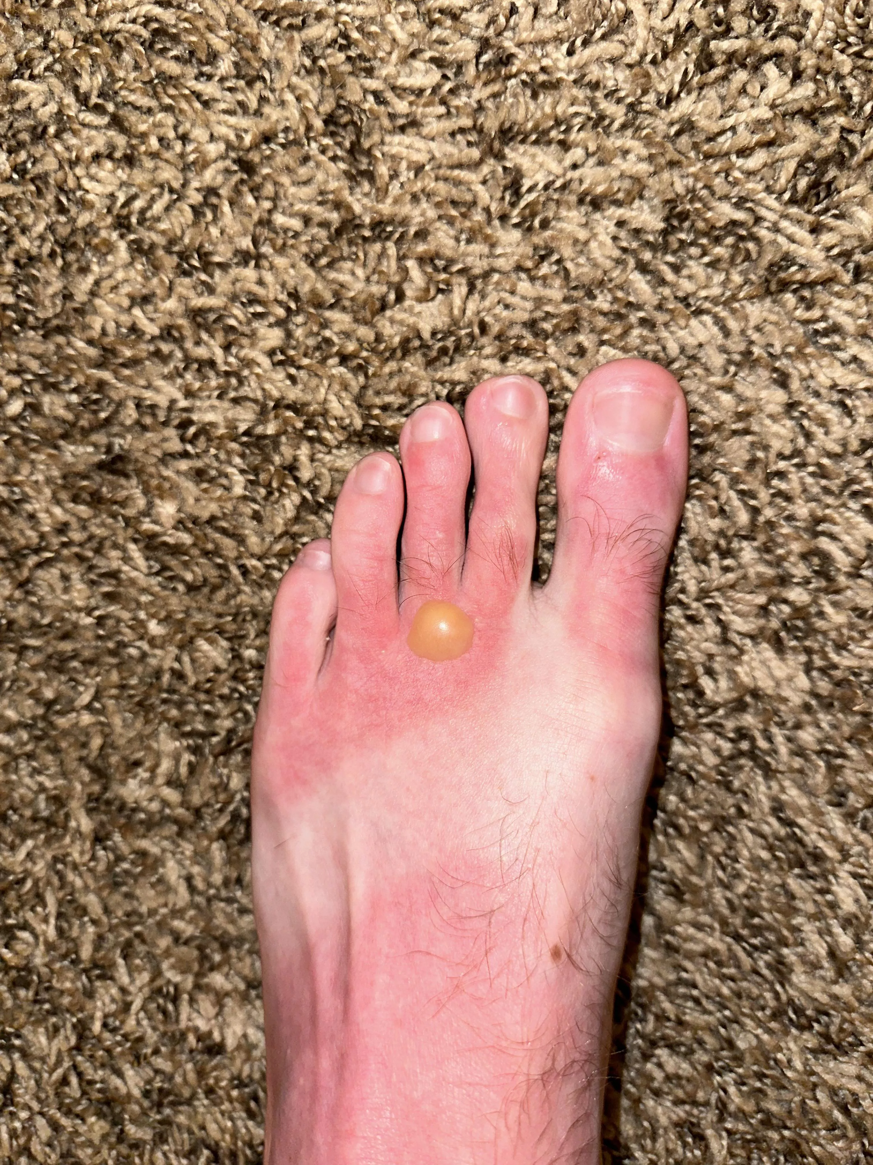 PSA: wear your sunscreen posted by Fullsenderson