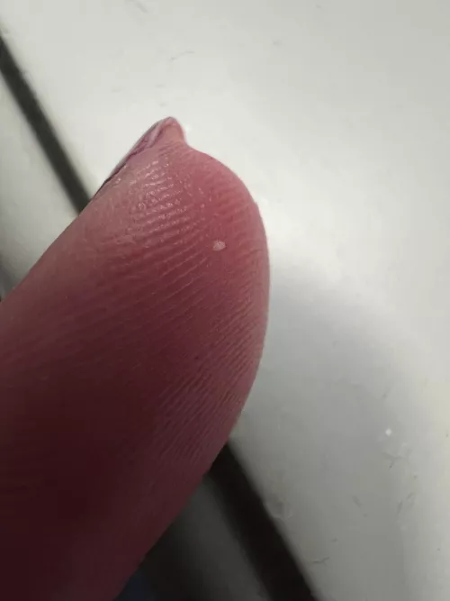 milia from forehead finally cut it out! by harbulary_Batteries_