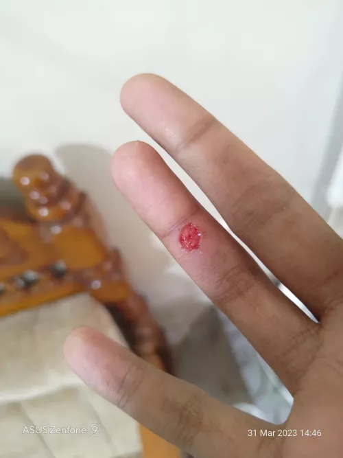 Wart that has been bothering me for more than year, Finally decided to see cosmetic dermatologist and cleared it using co2 laser treatment by Shdshahid0