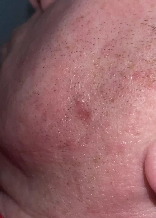 Could this be an ingrown hair? by BobbyPeel77