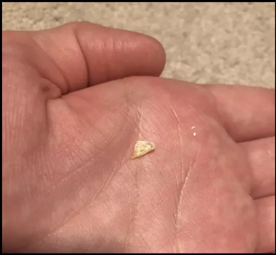 Ear felt blocked. Doctor checked and assured me no wax blockage. At home this chunk of dry skin fell out. by InternalizedIsm