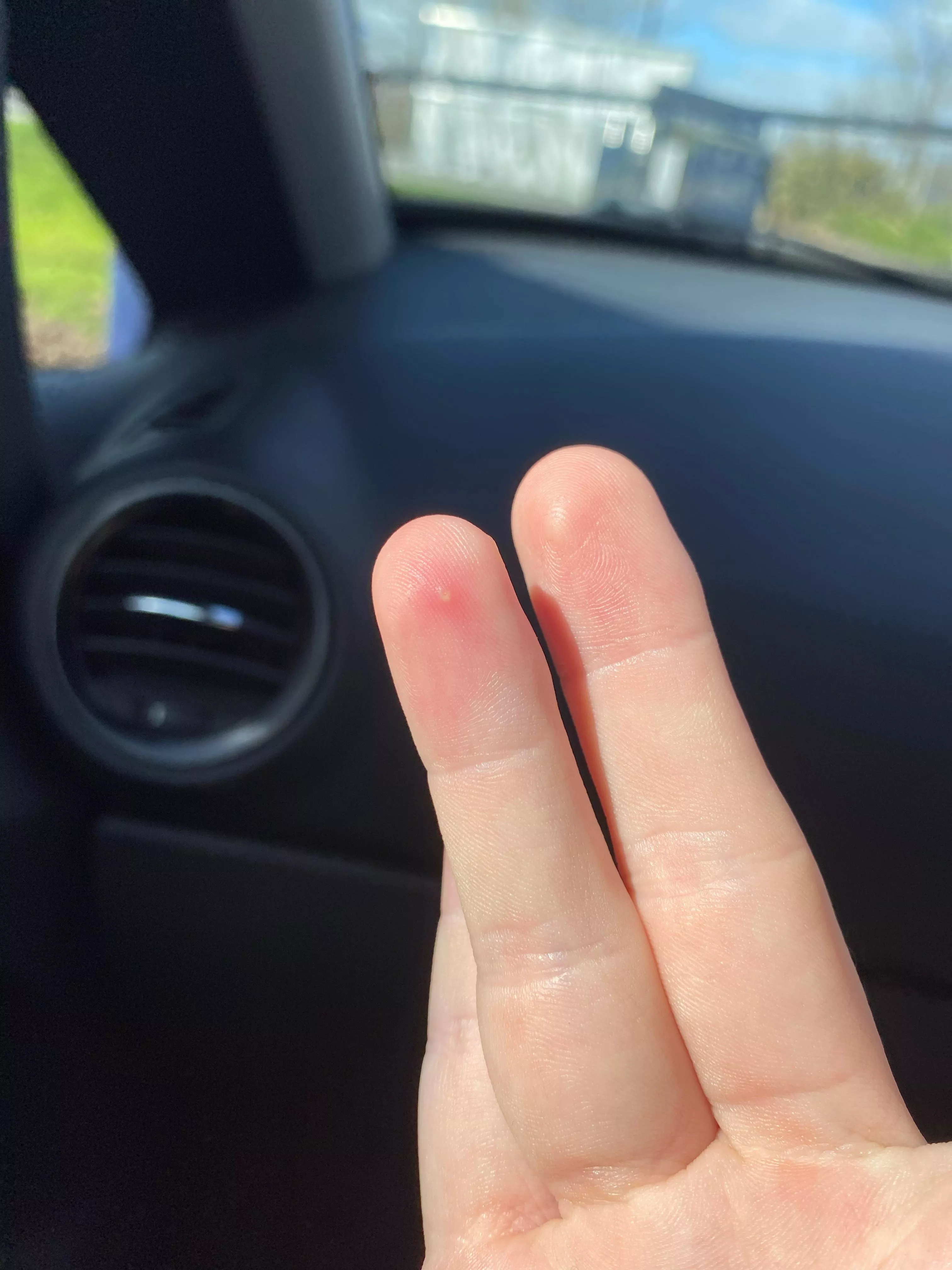 What is this little white spot on my finger? Stingy when touched doesn’t feel like a splinter posted by xmaniv