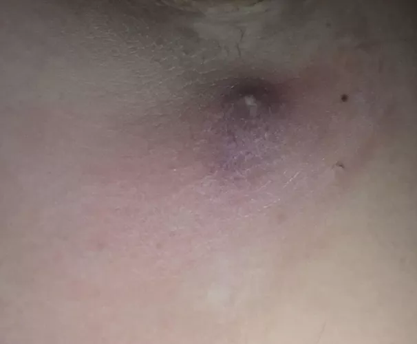 Cyst in armpit ready to burst by angela306