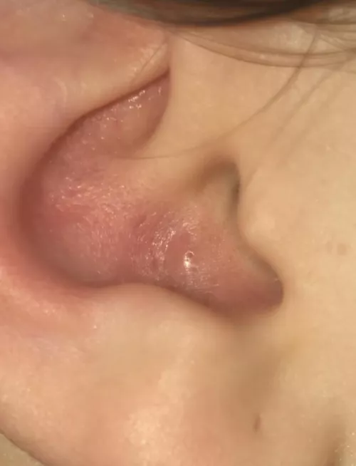 mega painful pimple in my ear by Sa1ntJ1mmy