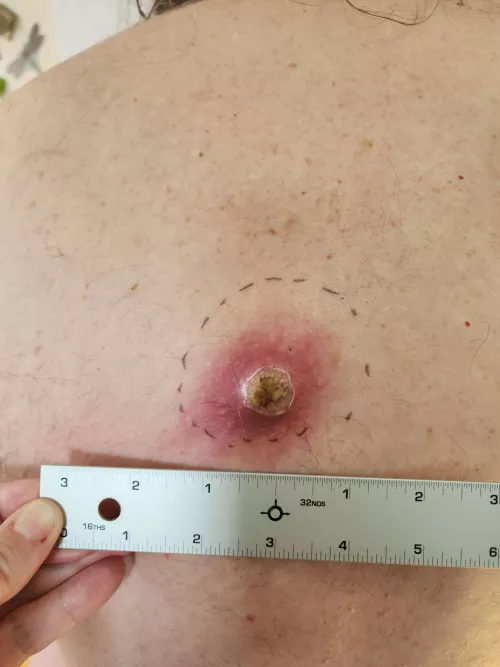 Preview - Angry Back Cyst by kapdad