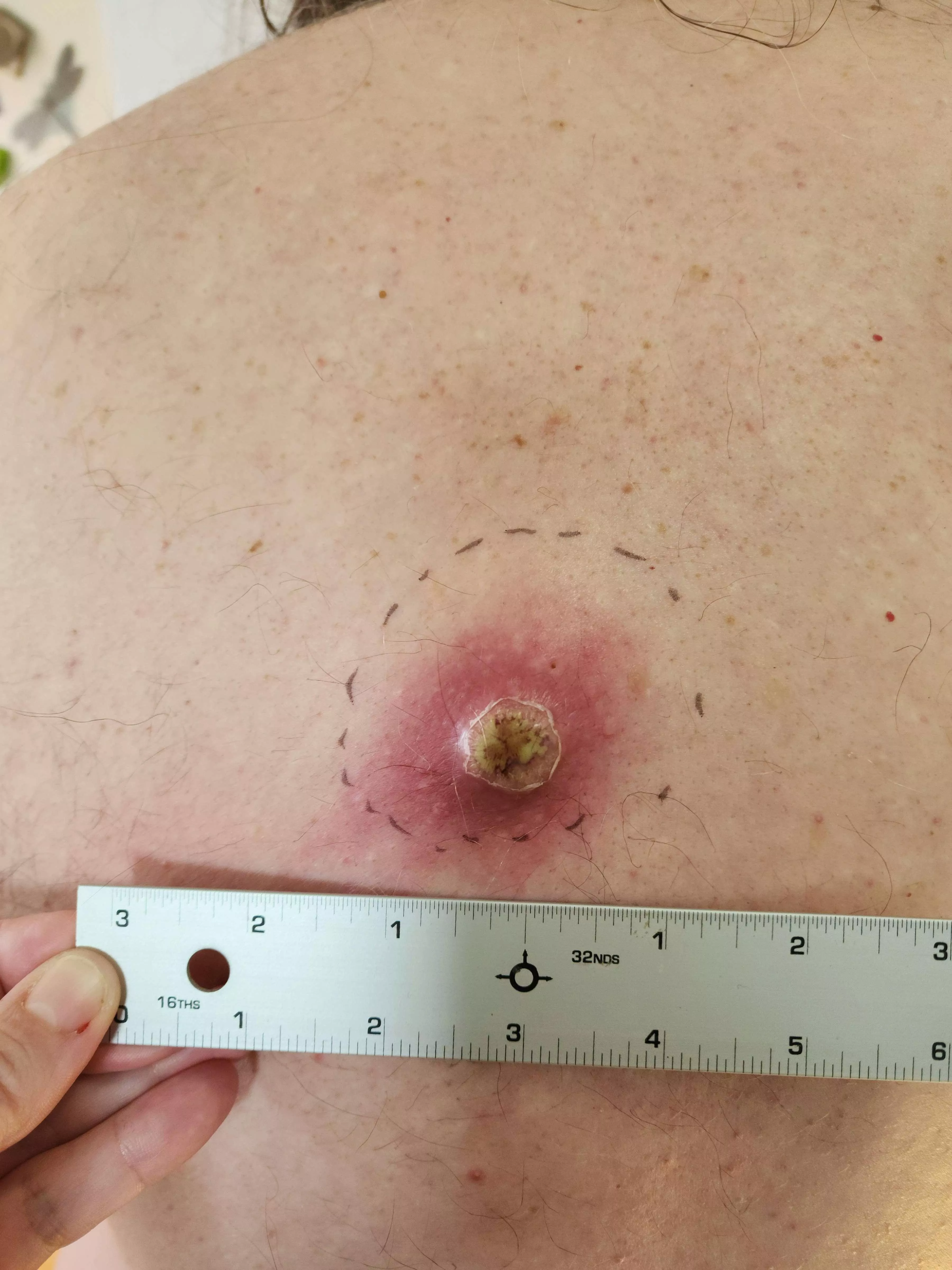 Preview - Angry Back Cyst posted by kapdad