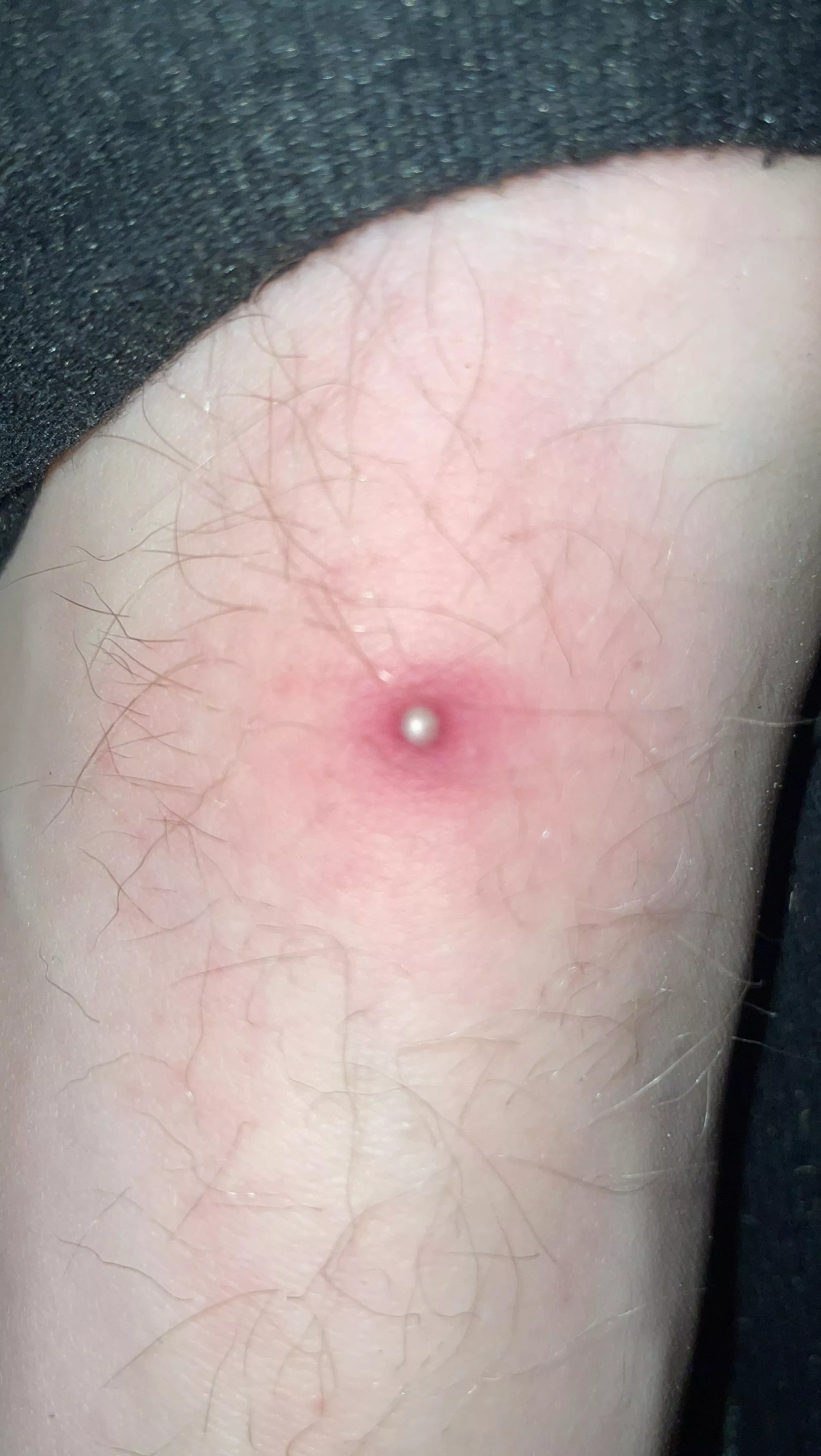 Can this be popped? And what is it exactly? I can barely put on my shoe, hurts a lot when touched. posted by notsigjnf