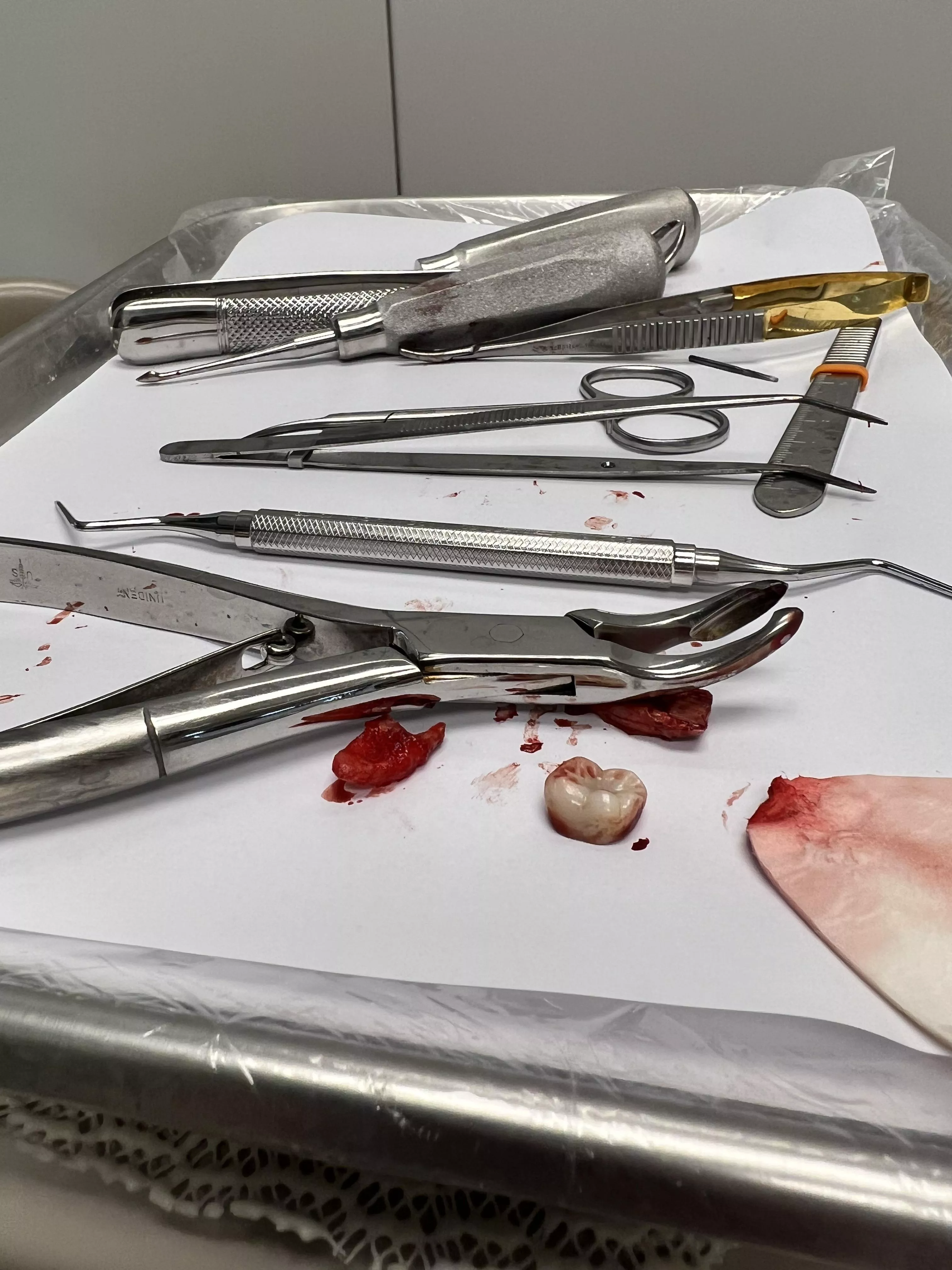 Remains of tooth extraction posted by panjier84