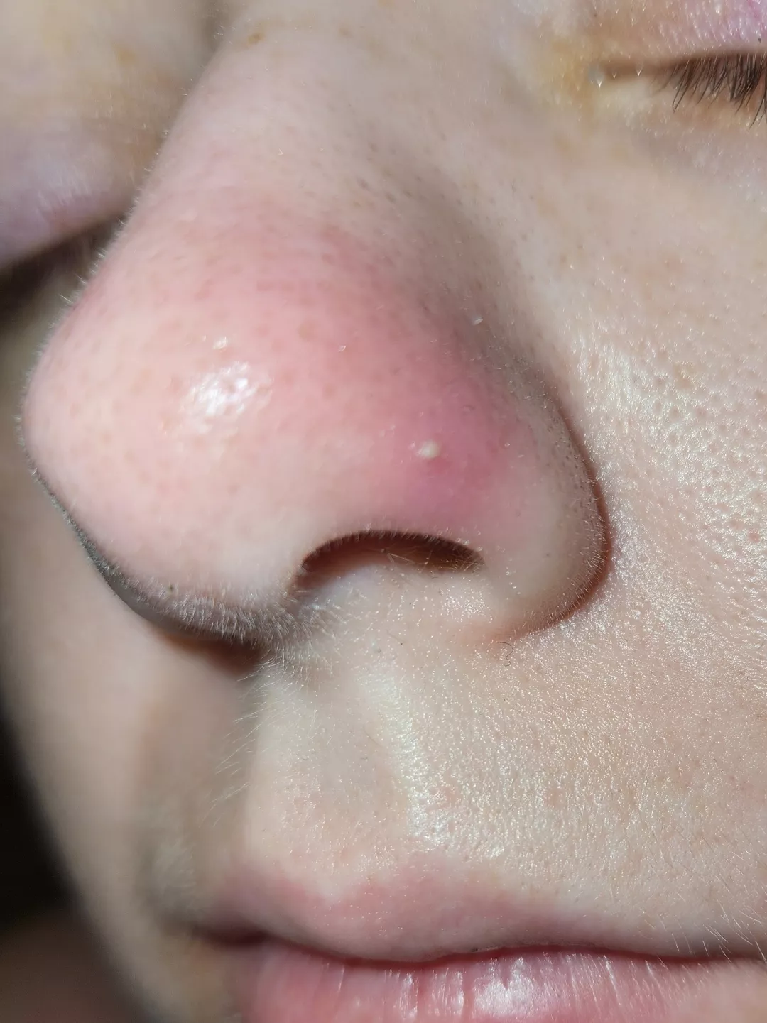 I'm not supposed to pop this, but it's almost too tempting. It also is super painful. posted by quietmania